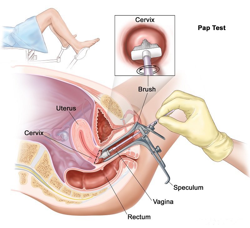  khám sàng lọc ung thư cổ tử cung