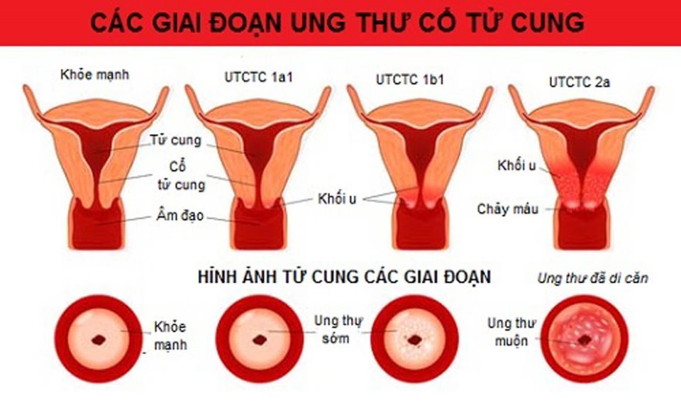 Bệnh ung thư cổ tử cung