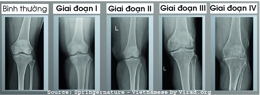 Thoái hóa khớp gối trên film Xquang