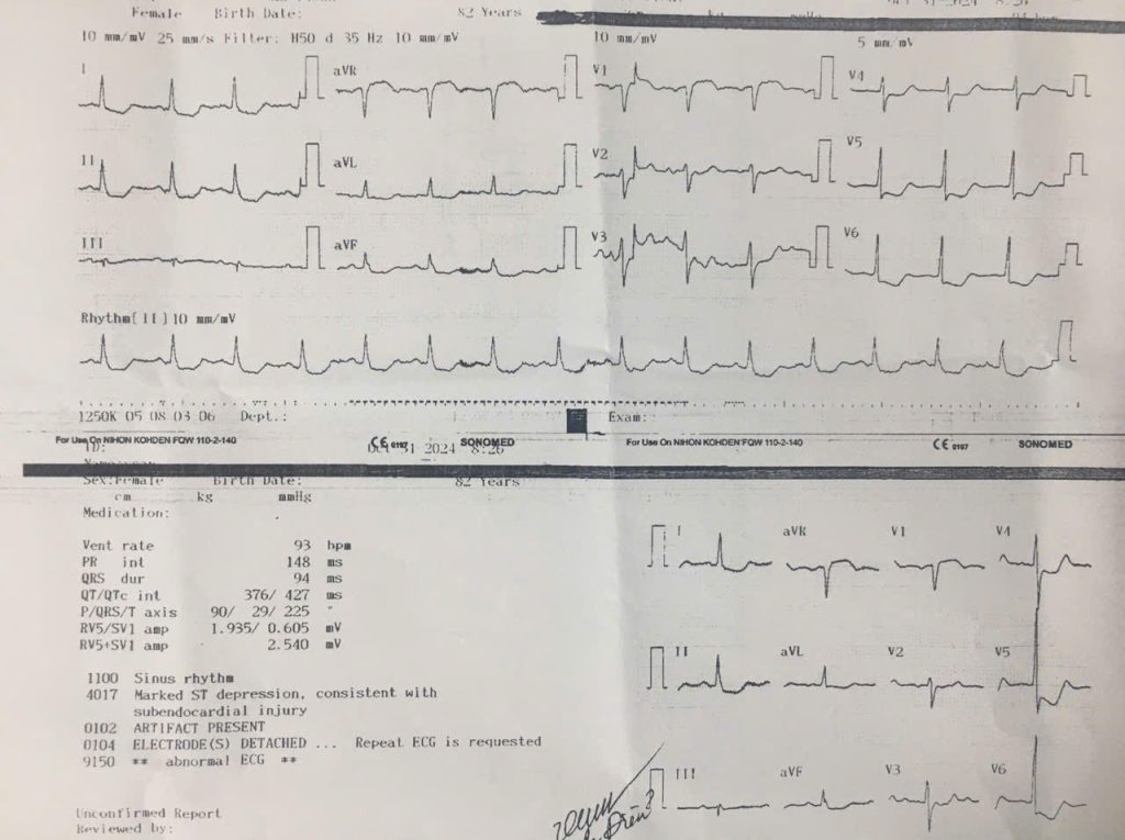 Ca bệnh 02 ST và sóng T điện tâm đồ theo hướng dẫn của Doctor Chu.