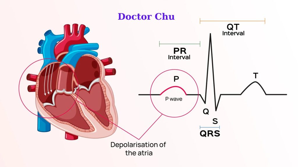 Sóng P trên điện tâm đồ