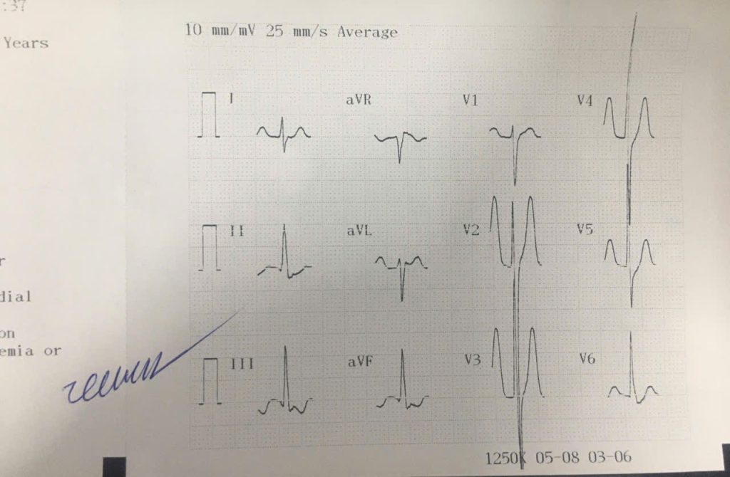 Sóng T điện tim doctor chu