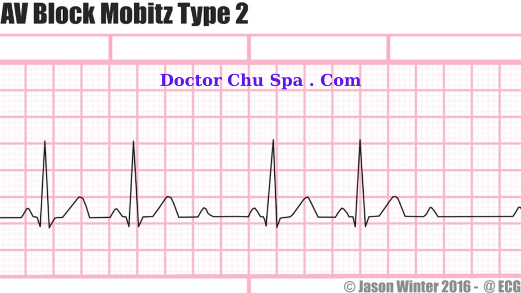 AV Block II Mobit 2: Điện tâm đồ block nhĩ thất độ II kiểu Mobit typ 2