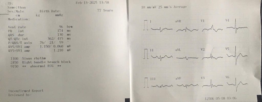 RBBB ECG guide by Doctor Chu