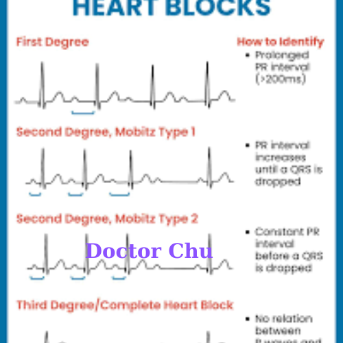 AV Block Grade II Block nhĩ thất độ 2