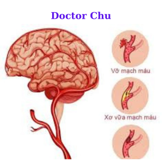Doctor Chu . phục hồi chức năng đột quỵ não tại bắc ninh